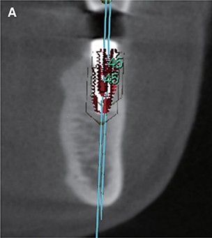 동암 치과 임플란트 CBCT 분석 이미지