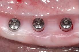 동암 치과 임플란트 적응증 CBCT