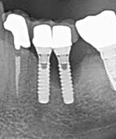 간석동 치과 임플란트 주위염 CBCT 분석