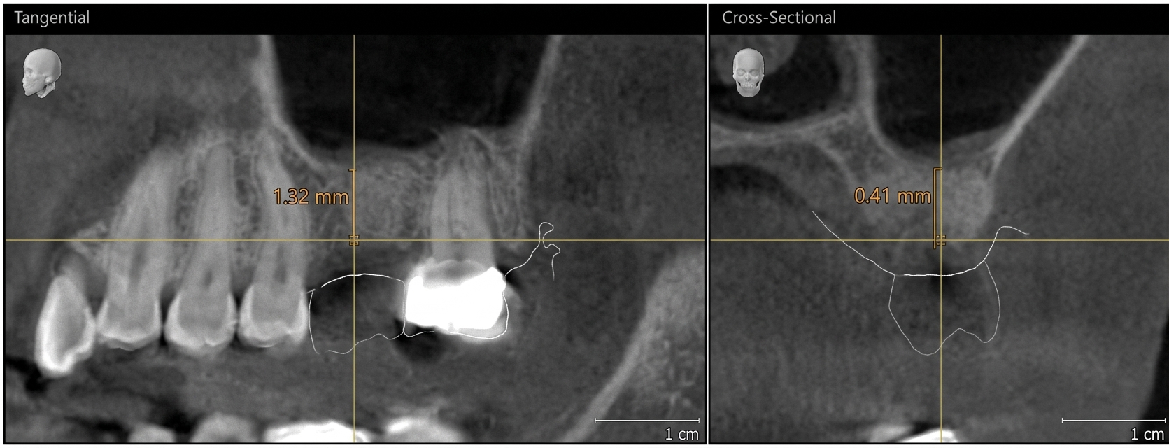 부평 치과 상악동 거상술 잔존골 높이 CBCT 계측 이미지