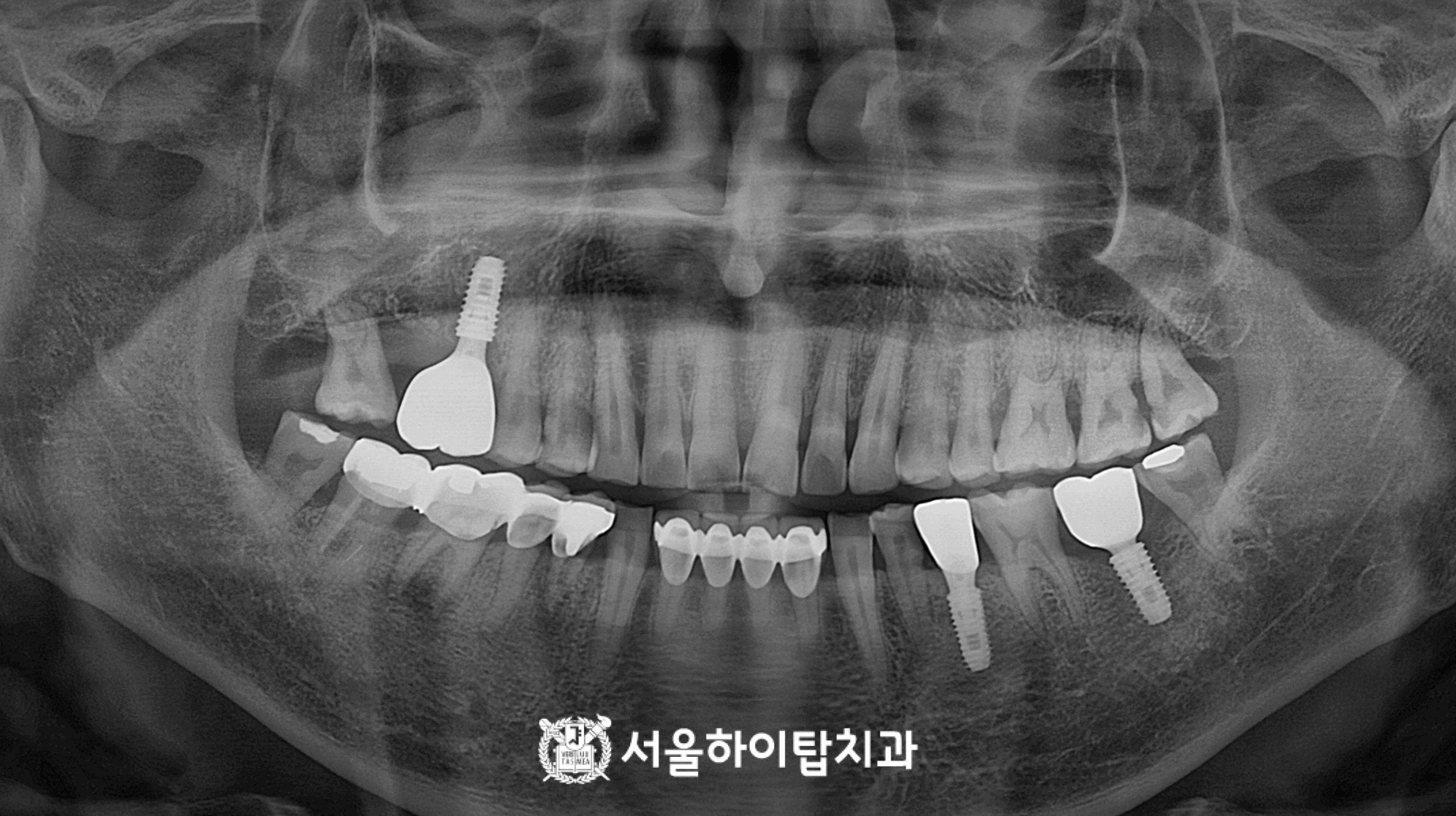 십정동 치과 임플란트 보철물 완료