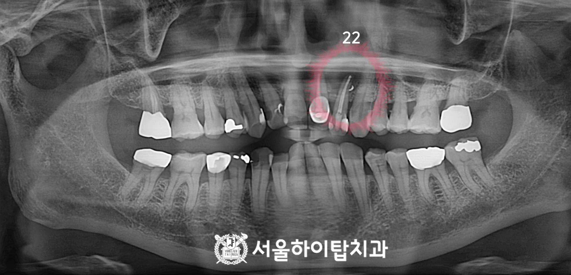 십정동치과 치근단절제술 초진 파노라마 방사선 사진 상악 좌측 측절치 염증