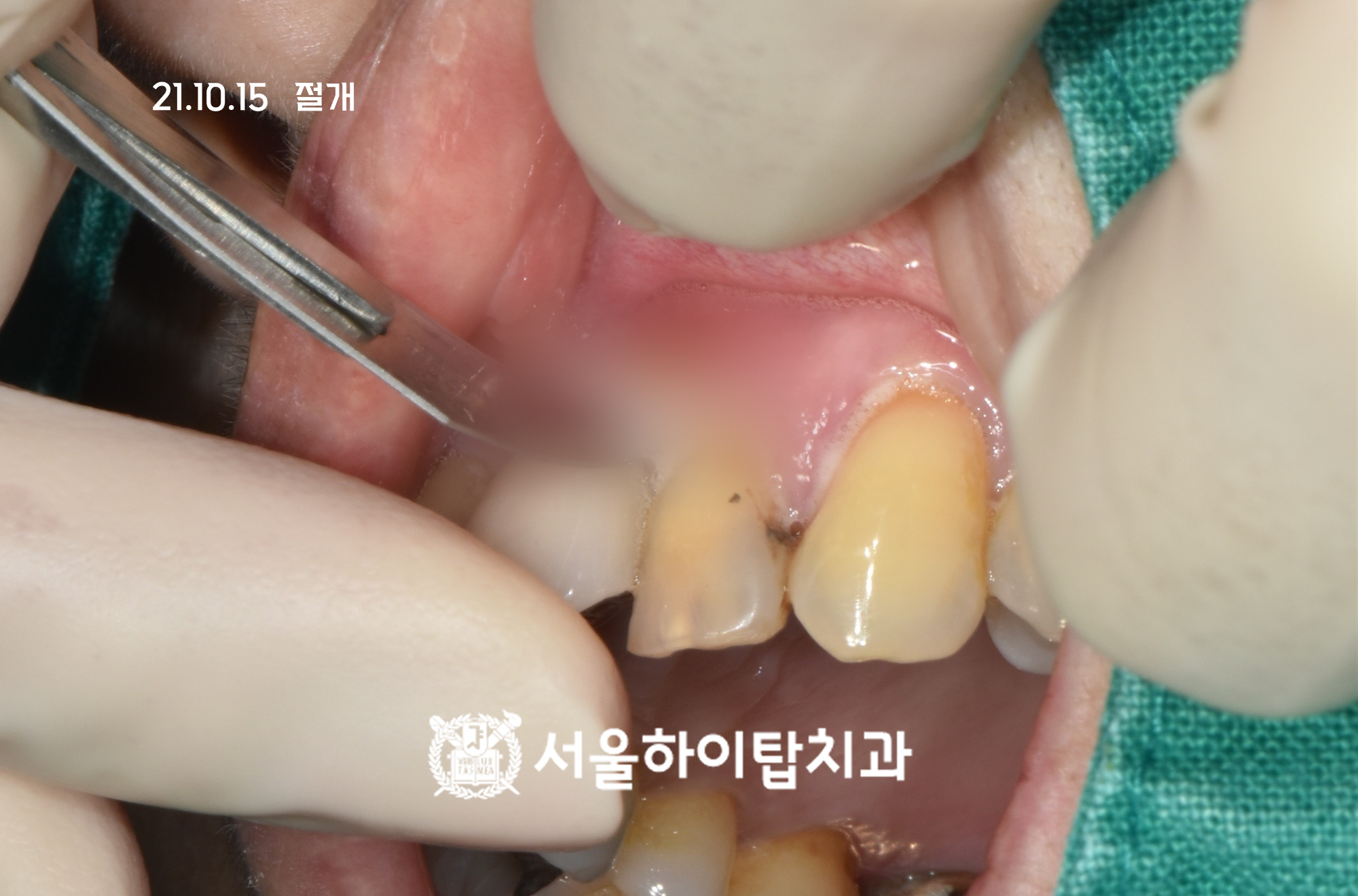 십정동치과 치근단절제술 잇몸 절개 과정 구내 사진