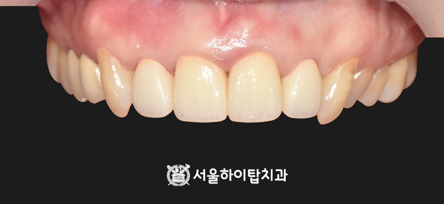 간석오거리역치과 재신경치료 후 보철 수복 사진