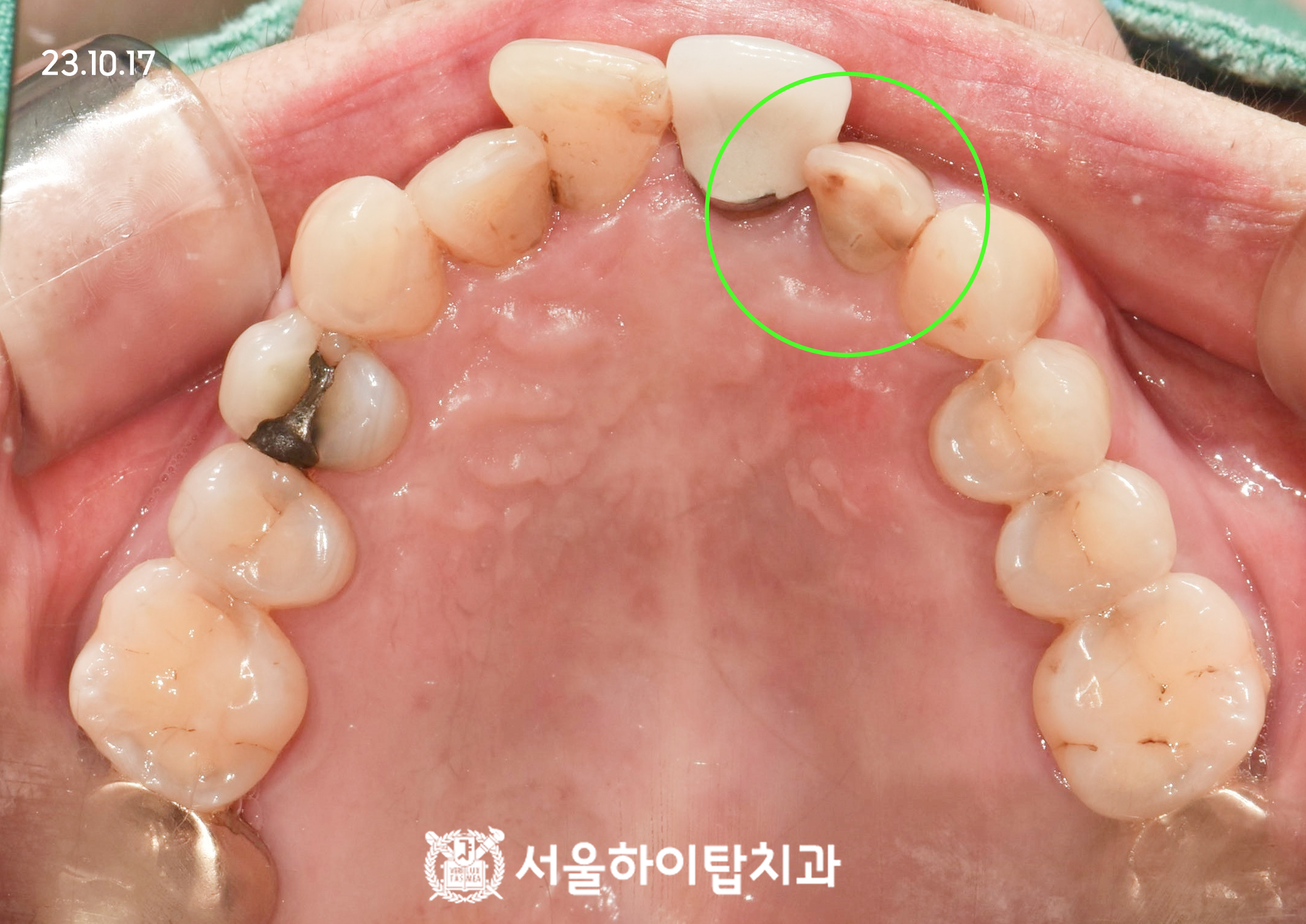 십정동치과 치근단절제술 2년 후 상악 구내 사진 보철 분리 상태