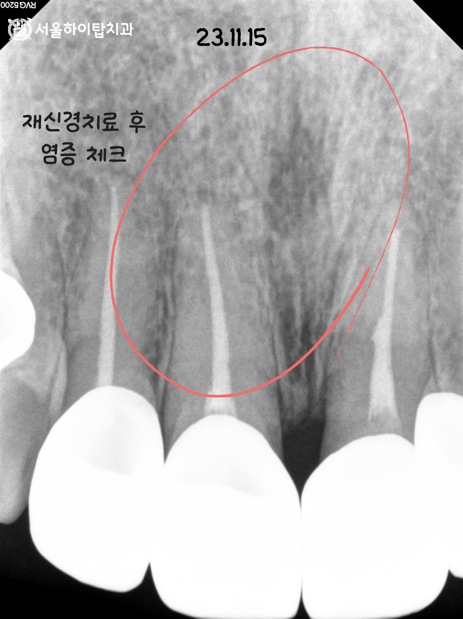 간석오거리역치과 재신경치료 후 추적관찰 방사선 사진