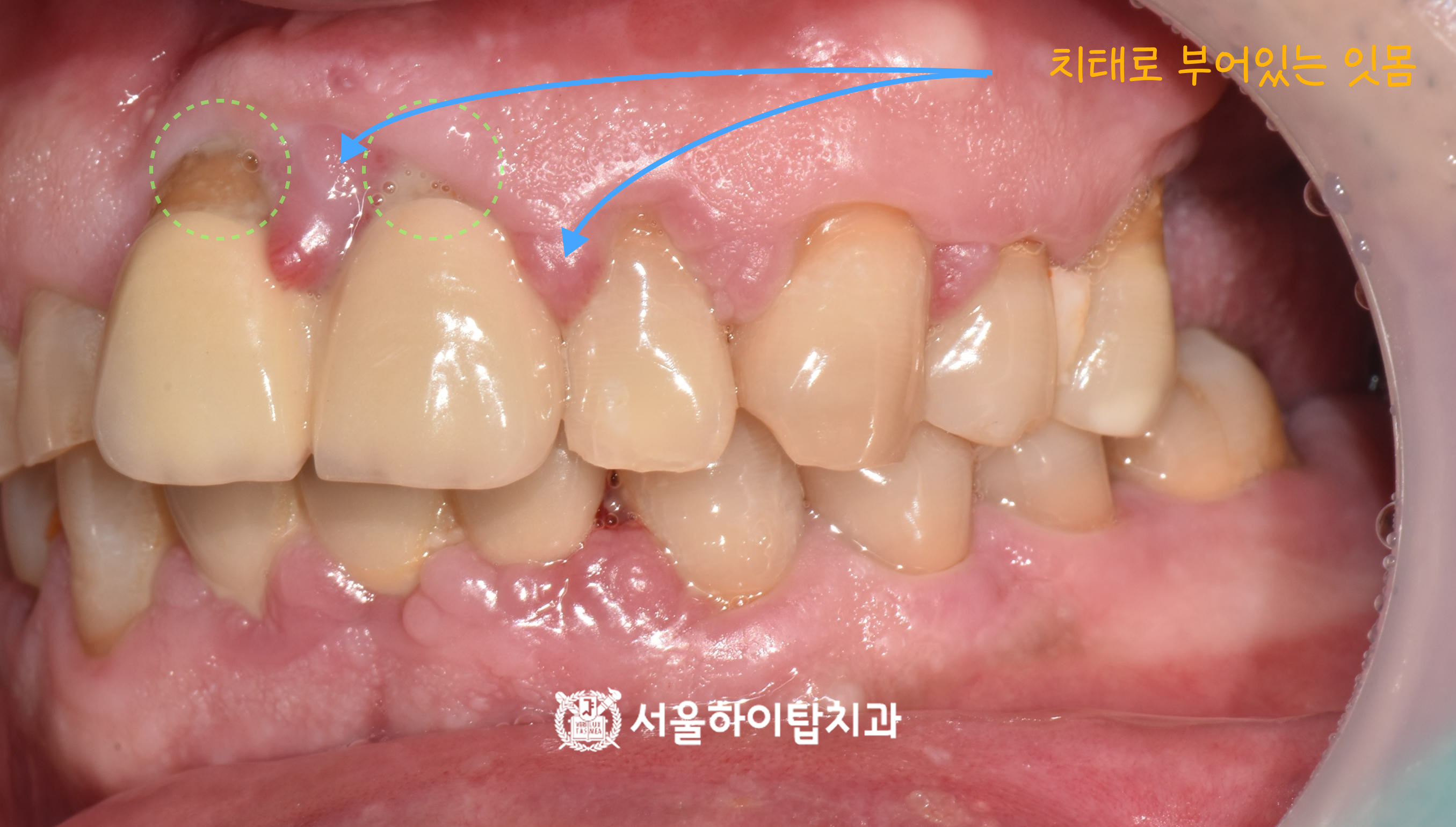 동암역치과 잇몸 정밀 검진 이미지