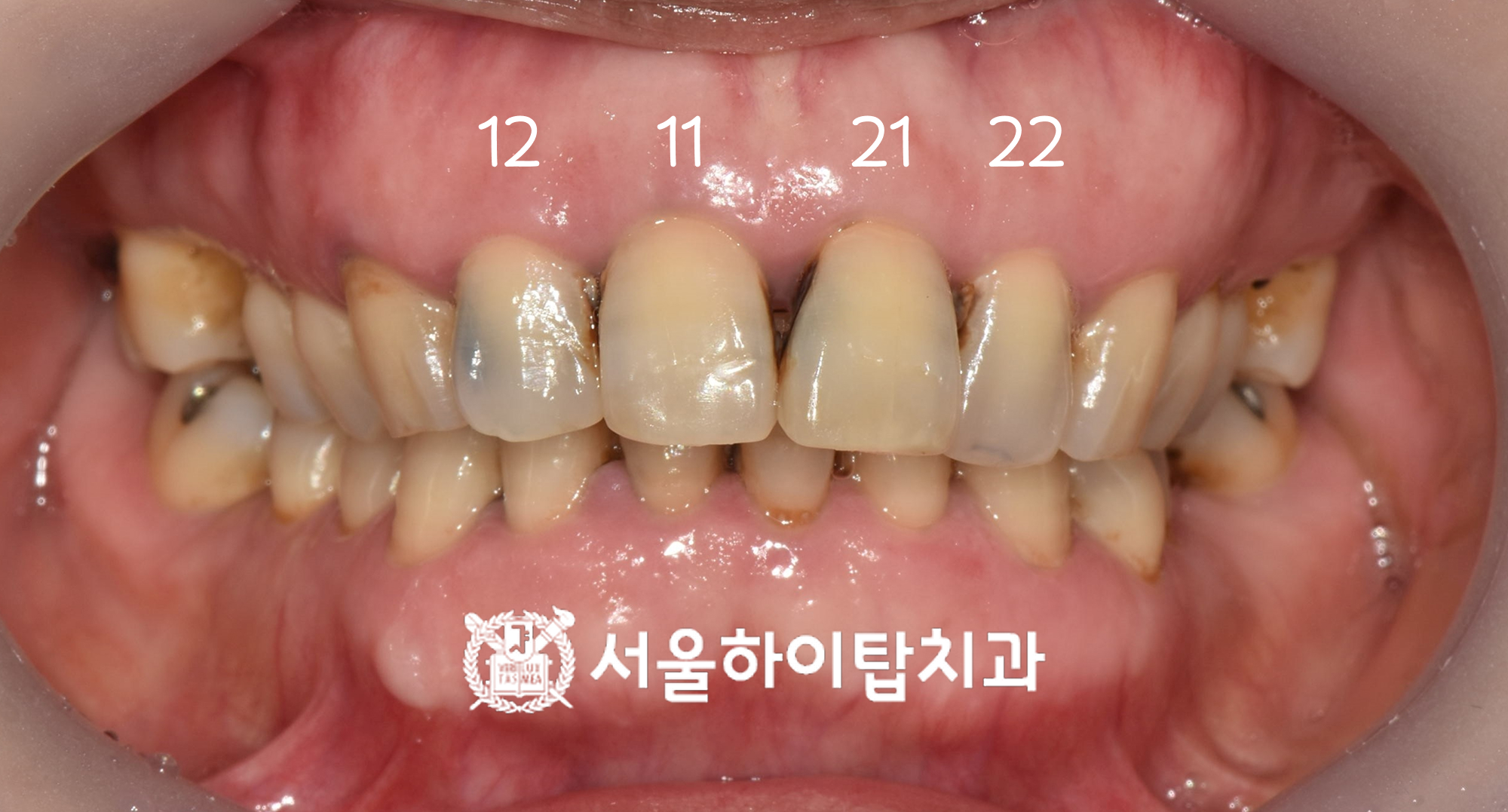 십정동치과 라미네이트 크라운 전환 진단 이미지