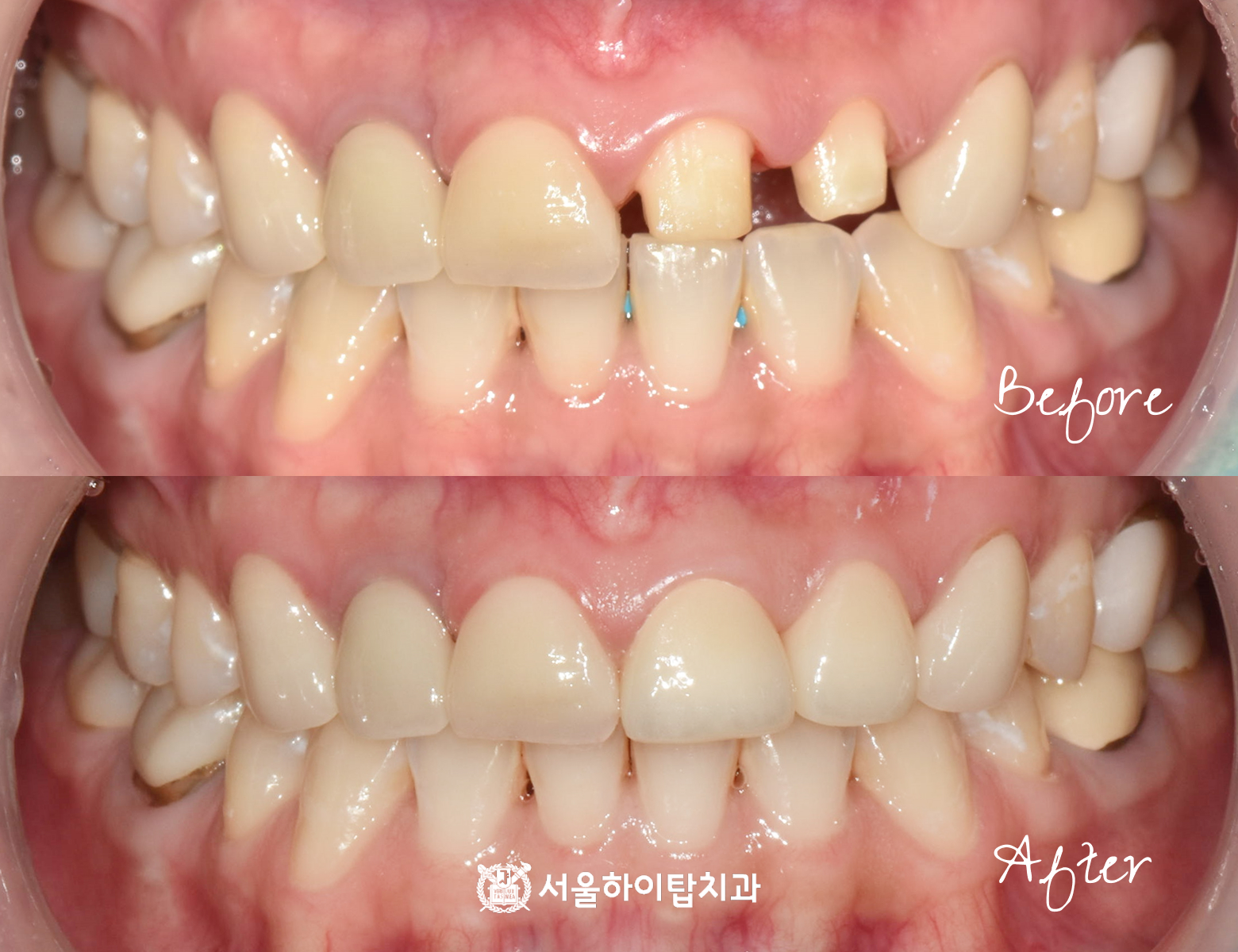 십정동치과 앞니 심미보철