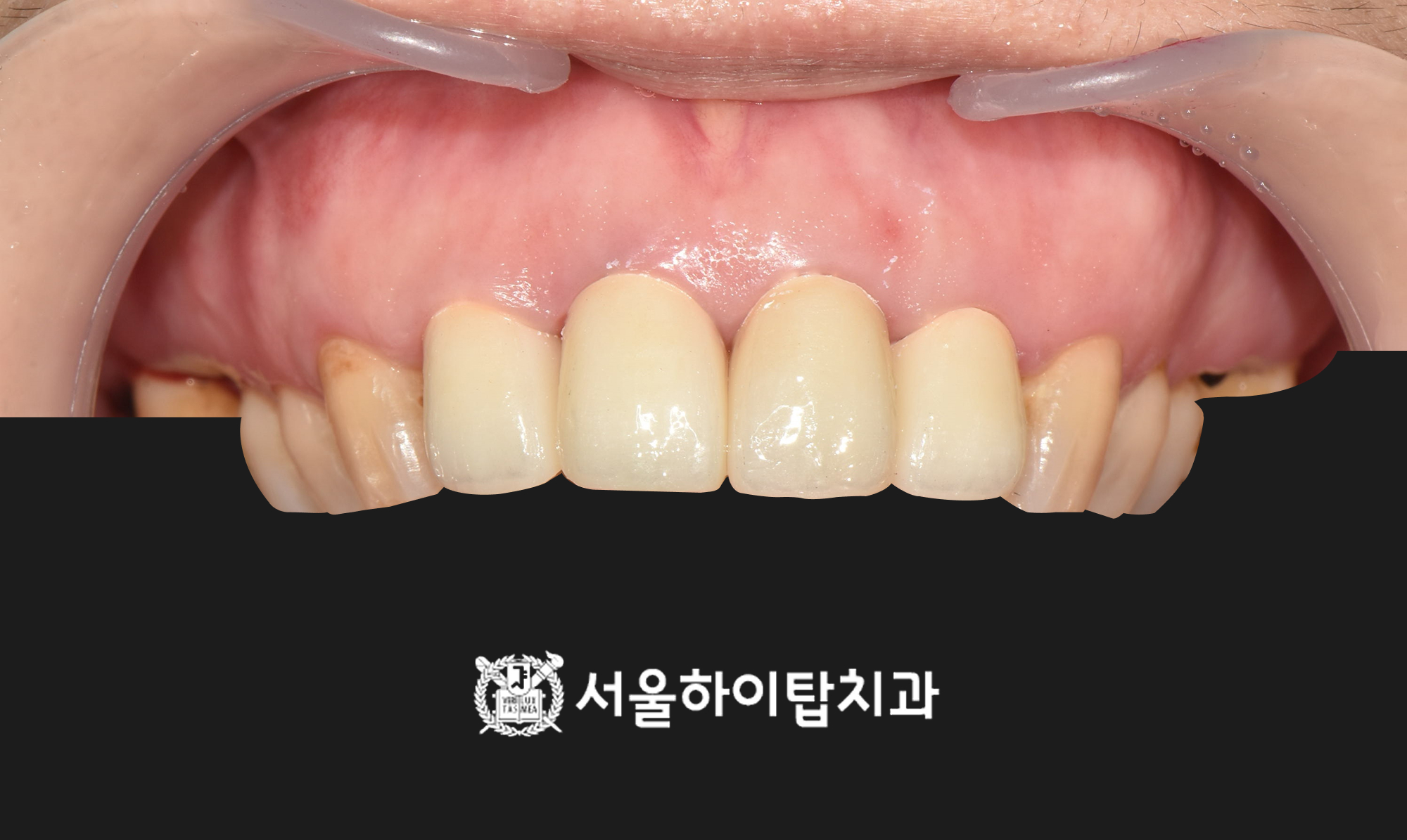 십정동치과 라미네이트 크라운 전환 진단 이미지