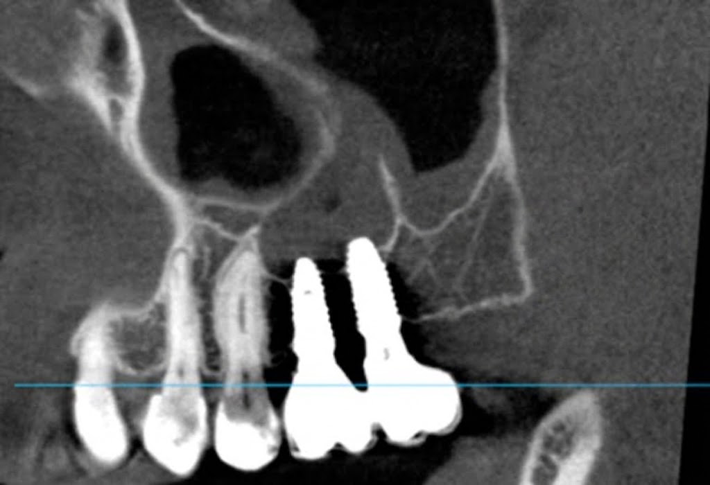 부평 십정동치과 임플란트 재수술 계획을 위한 상악 구치부 CBCT 단면 영상