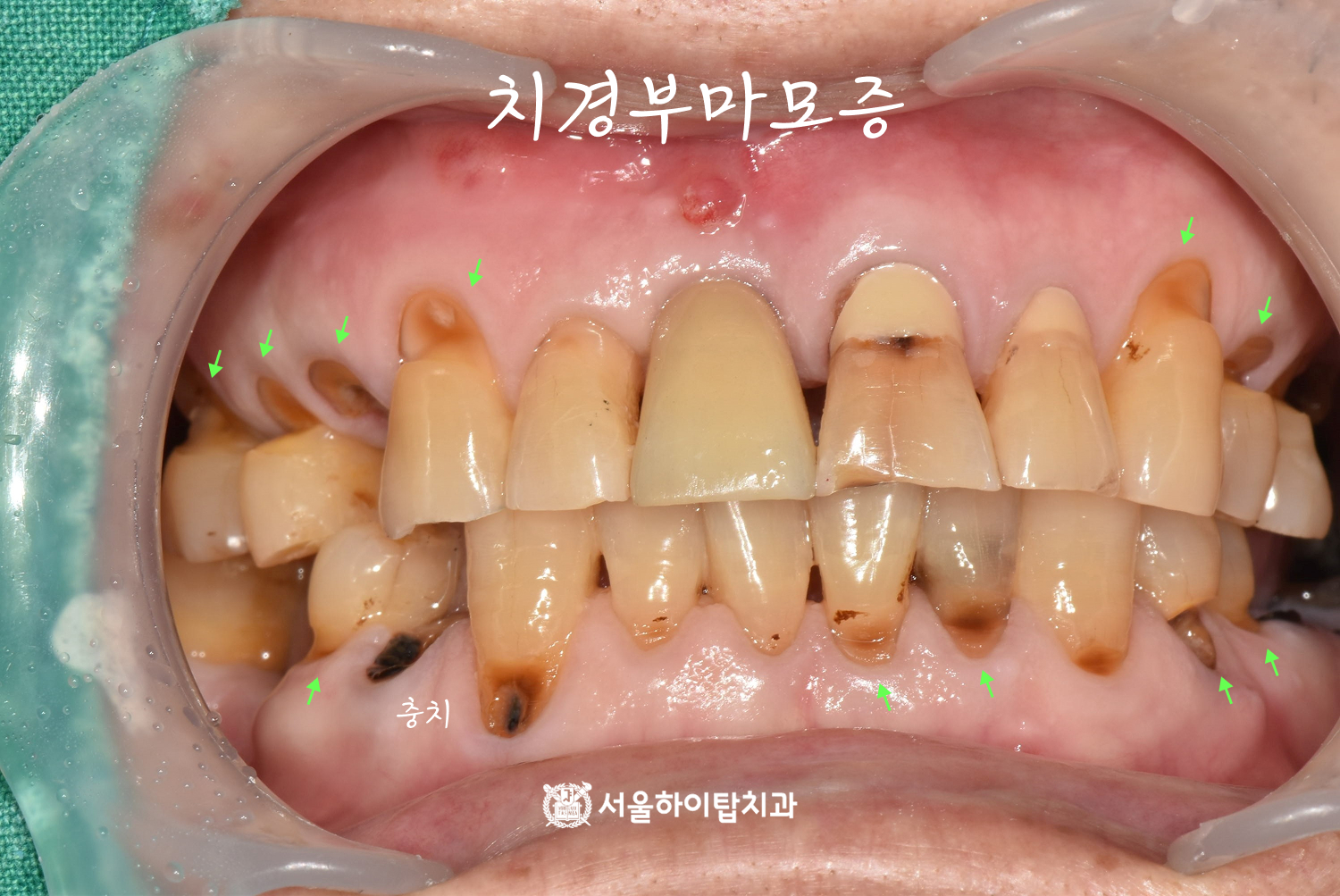 부평역치과 치관 파절 위험이 있는 심한 치경부마모증 사진
