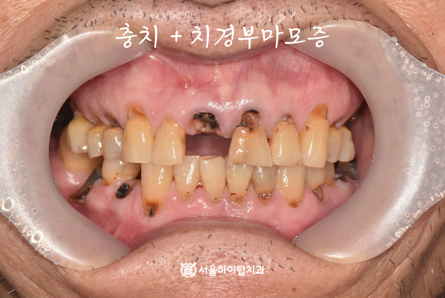 부평역치과 심한 충치와 치경부마모증이 함께 진행된 치아 사진