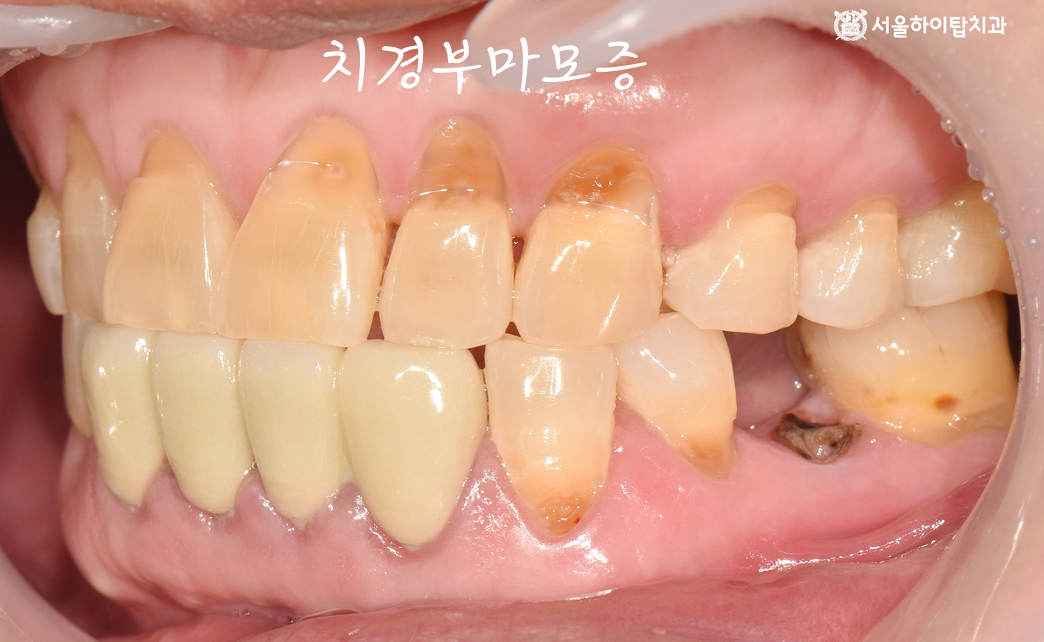 부평역치과 보통 정도의 치경부마모증 좌측 치아 사진