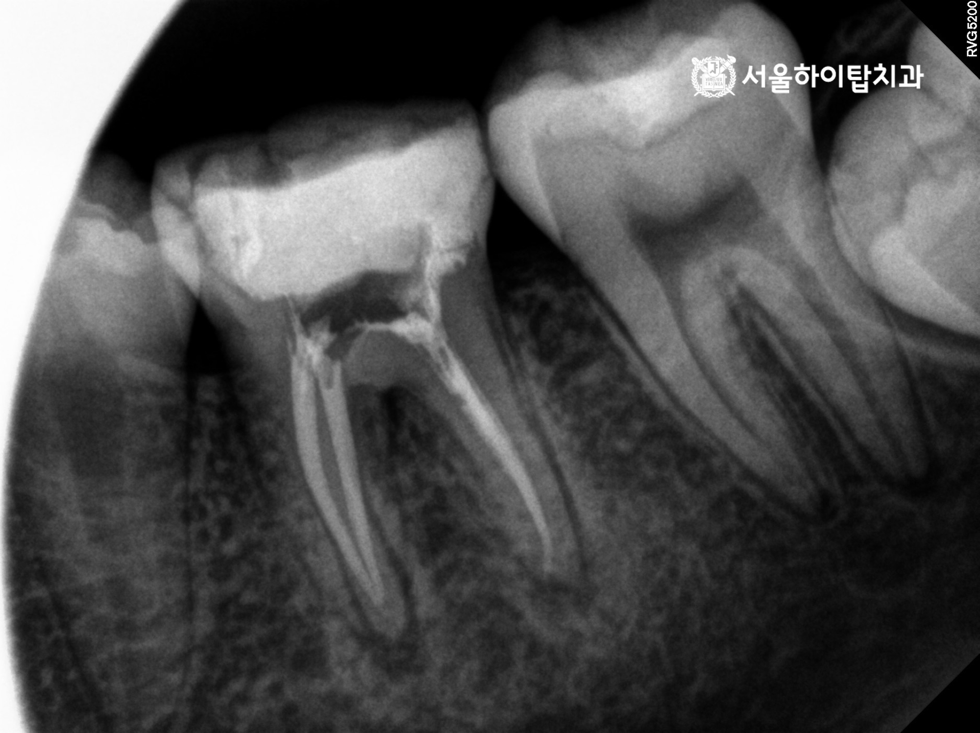 주안역치과 36번 치아 신경치료 완료 후 사진