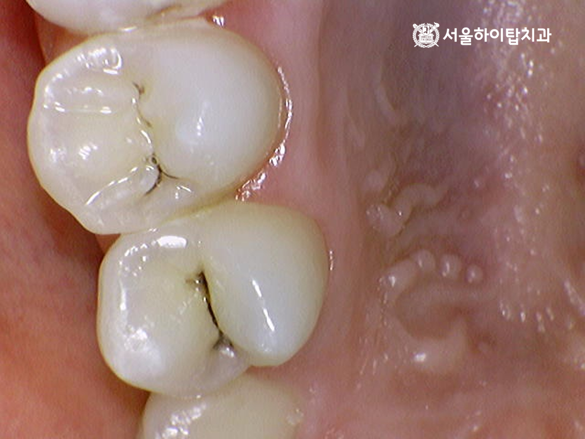 주안역치과 상악 소구치 작은 충치 사진 2