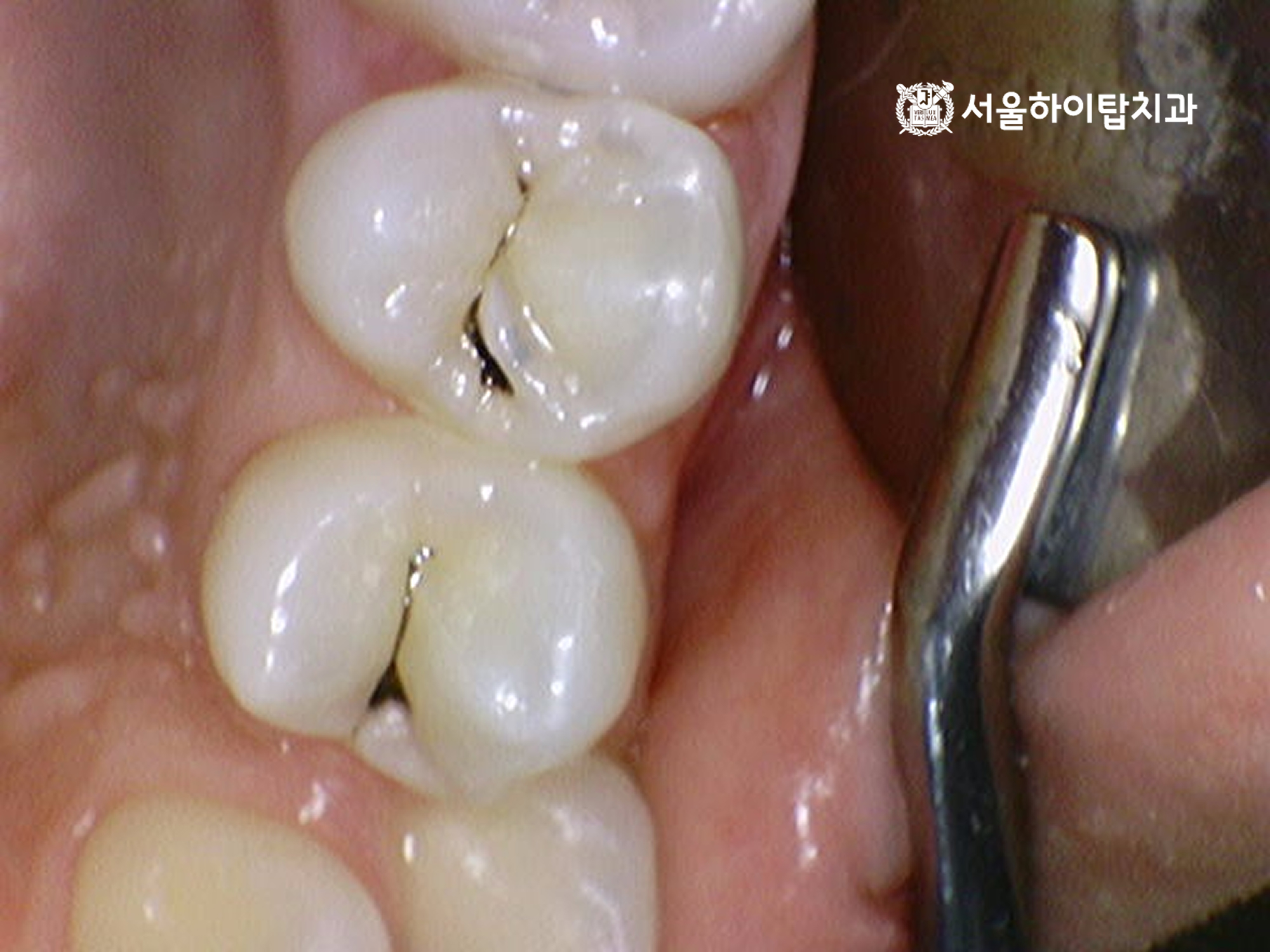 주안역치과 상악 소구치 작은 충치 사진 1