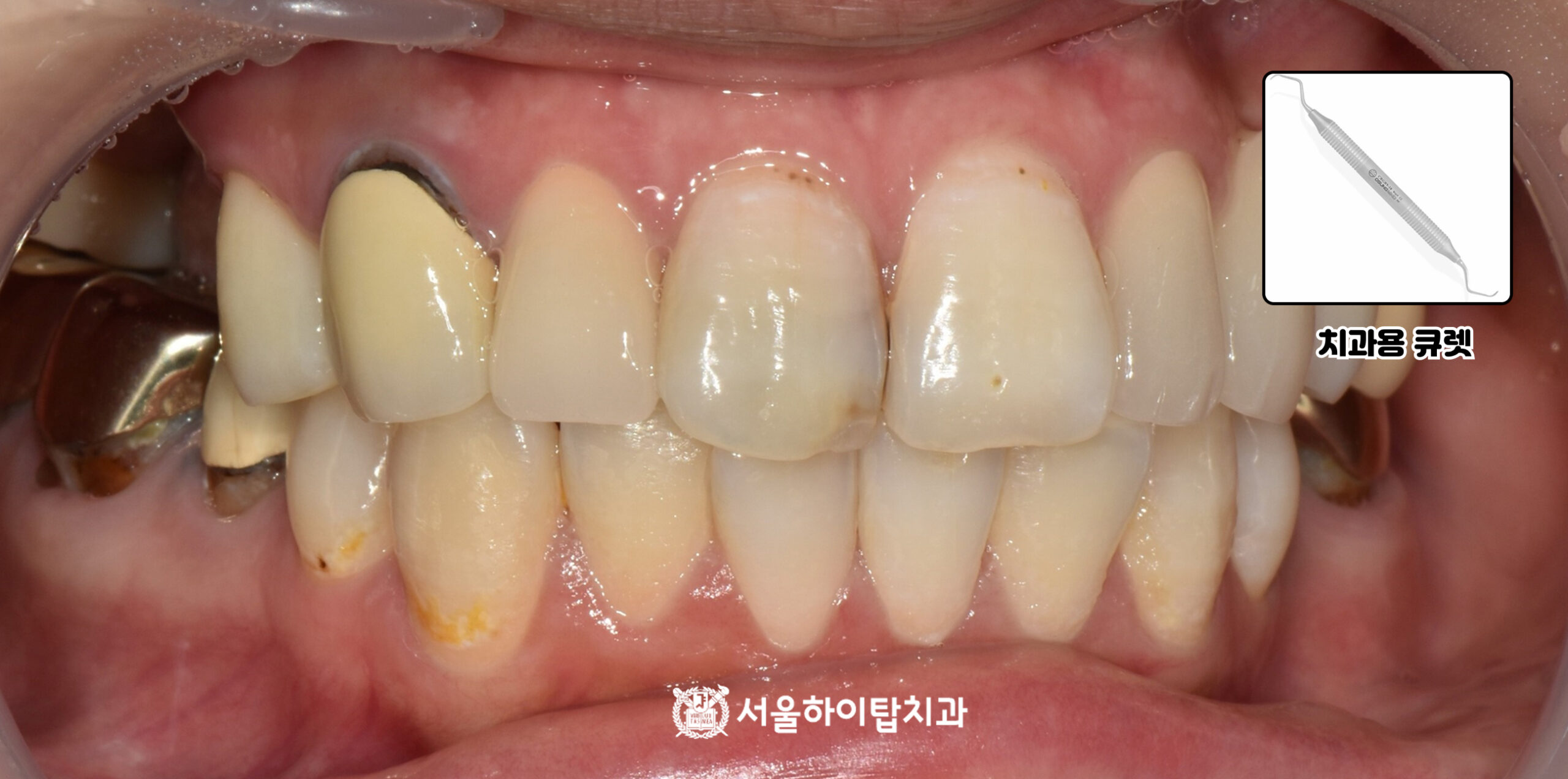 부평 동암역치과 치근활택술 전 치아용 큐렛 기구 사진