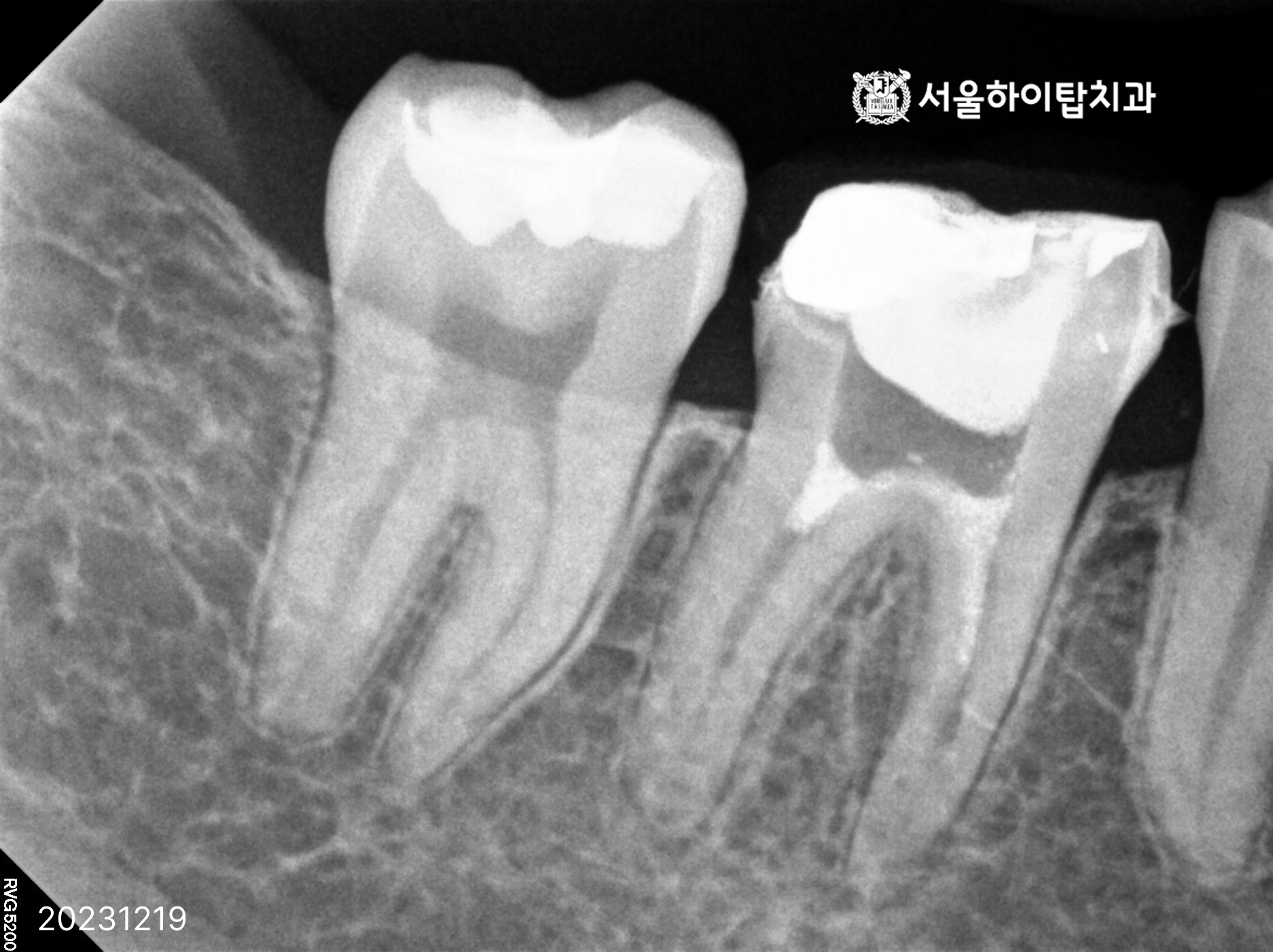 동암치과 막힌 신경관 위치를 확인하는 CBCT 3차원 영상