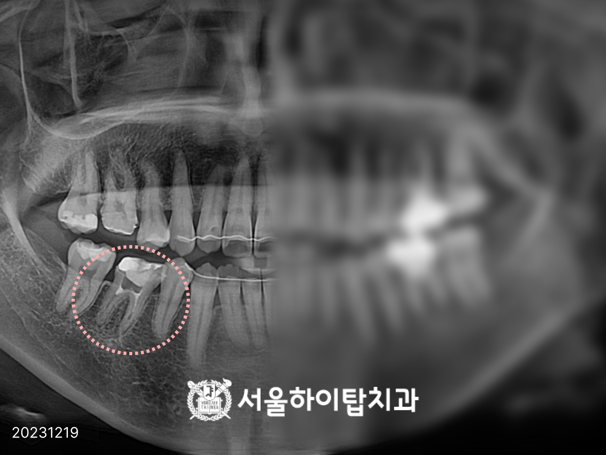 동암치과 신경치료 후 염증이 재발해 재신경치료가 필요한 치아 X-ray 사진