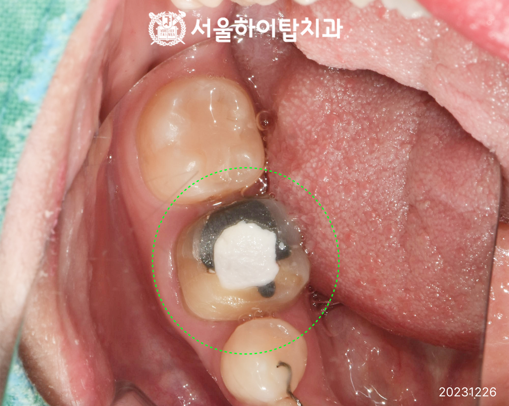 동암치과 막힌 신경관 재신경치료 중 구내