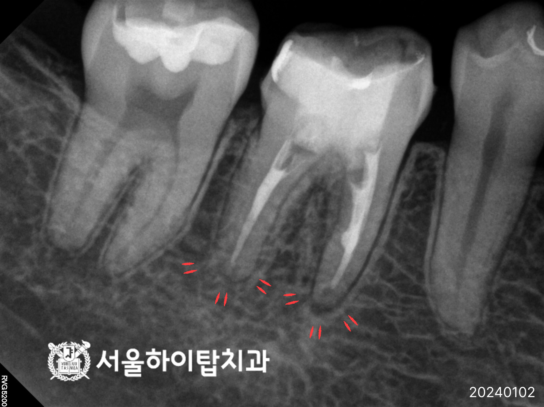 동암치과 재신경치료 후 경과 관찰 X-ray 사진