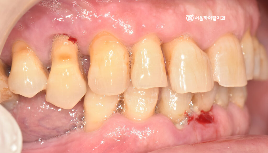 마모, 출형, 정출되어 치근이 보이는 모습