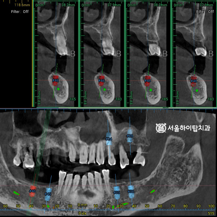 픽스처가 식립될 위치 시뮬레이션 및 
잔존 치조골의 높이, 밀도, 두께,
해부학적 구조물 등을 면밀히 분석