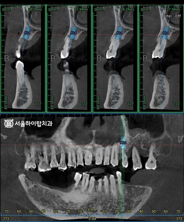 픽스처가 식립될 위치 시뮬레이션 및 
잔존 치조골의 높이, 밀도, 두께,
해부학적 구조물 등을 면밀히 분석