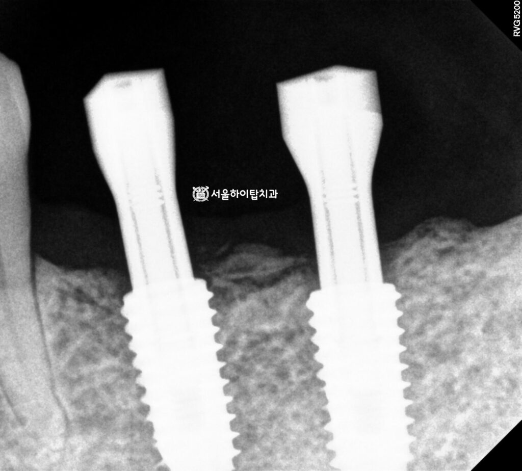 환자 맞춤형 보철을 제작하기 위한
스칸바디 체결 후 인상채득
