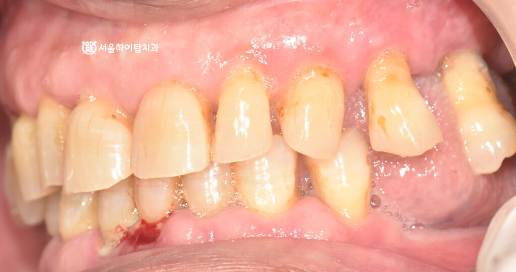 마모, 출형, 정출되어 치근이 보이는 모습