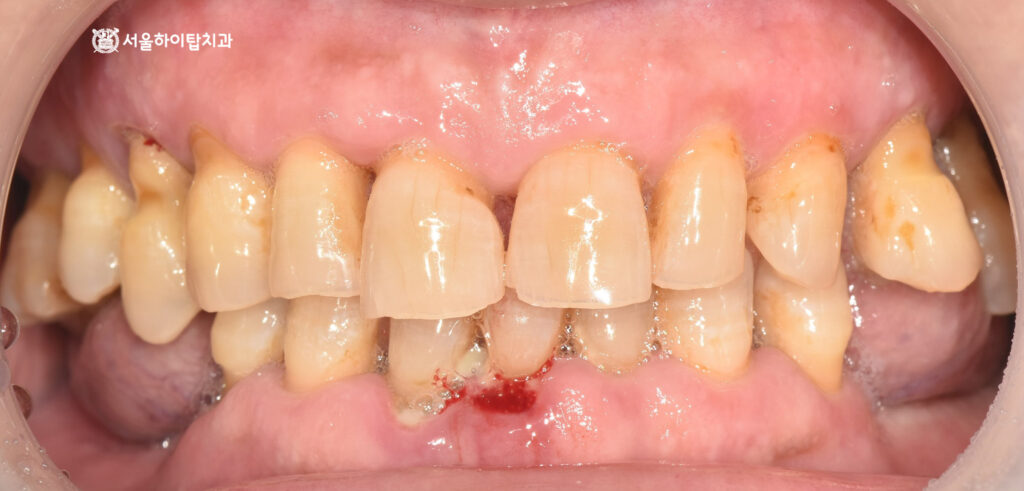 마모, 출형, 정출되어 치근이 보이는 모습