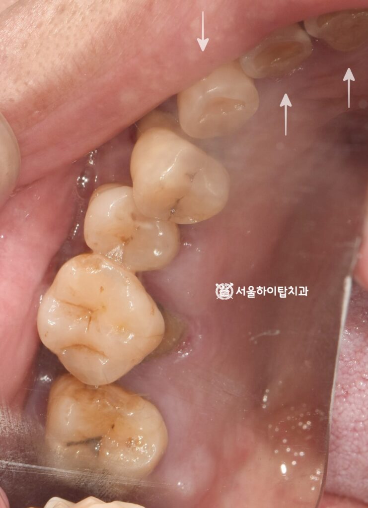 곳곳에 쌓인 플라그,
마모된 치아 교합면