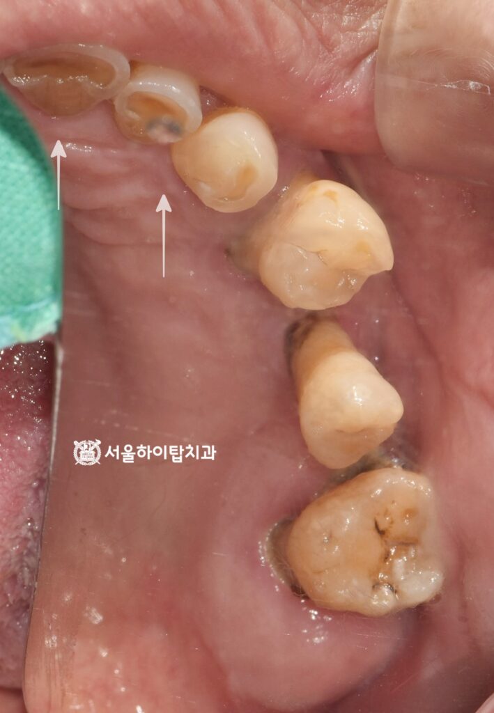 곳곳에 쌓인 플라그,
마모된 치아 교합면