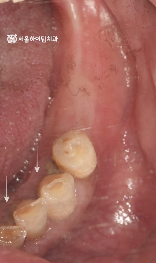 곳곳에 쌓인 플라그,
마모된 치아 교합면