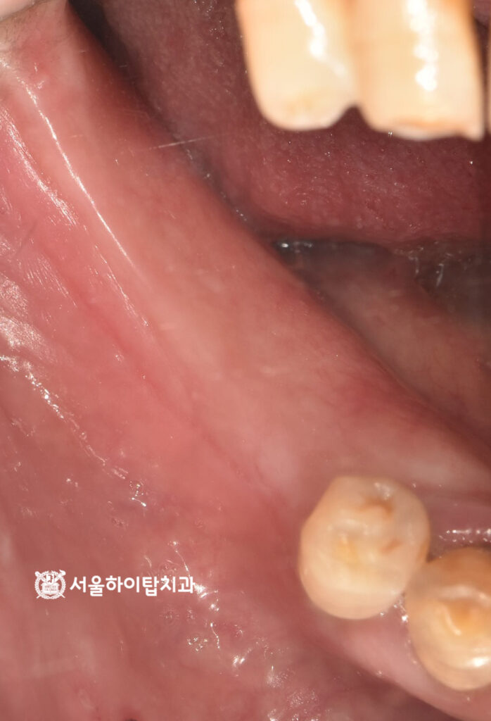 곳곳에 쌓인 플라그,
마모된 치아 교합면