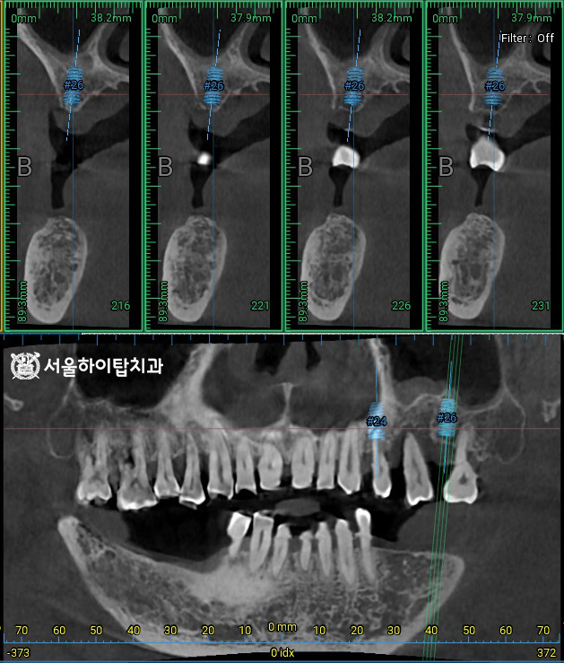픽스처가 식립될 위치 시뮬레이션 및 
잔존 치조골의 높이, 밀도, 두께,
해부학적 구조물 등을 면밀히 분석