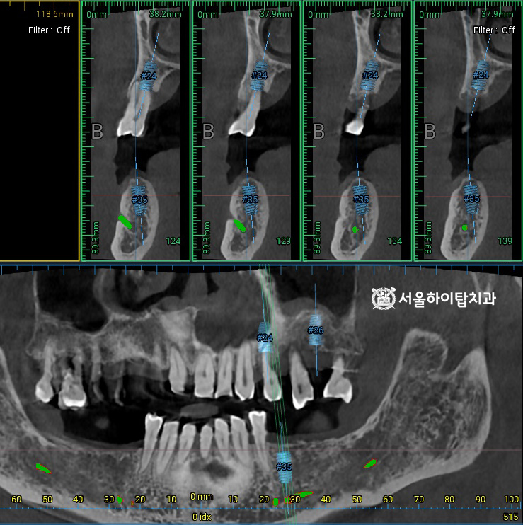 픽스처가 식립될 위치 시뮬레이션 및 
잔존 치조골의 높이, 밀도, 두께,
해부학적 구조물 등을 면밀히 분석