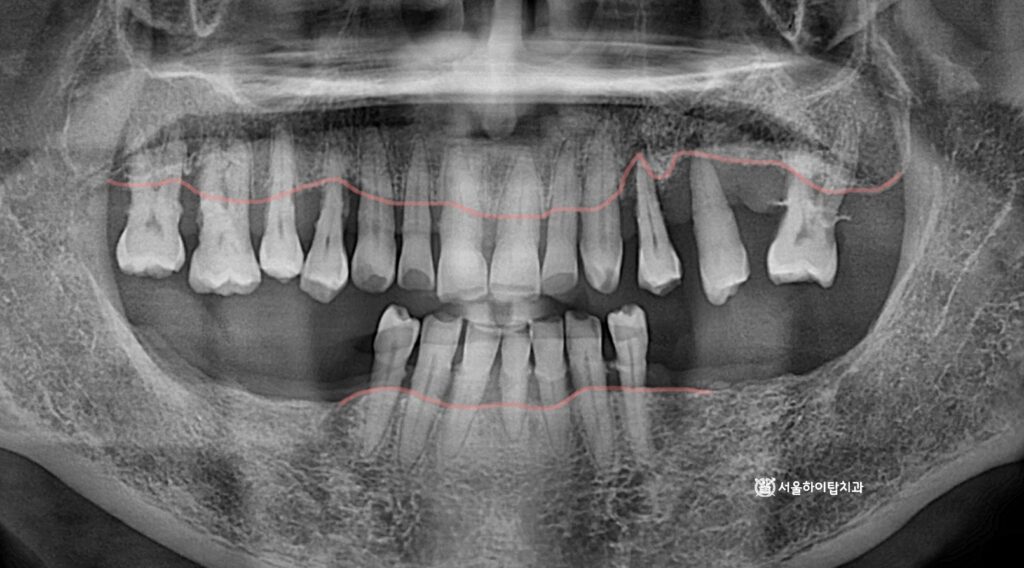 전체적으로 낮아진 뼈의 높이
치주염으로 인한 골 소실,

아래턱 양쪽 구치부 어금니가 모두 상실