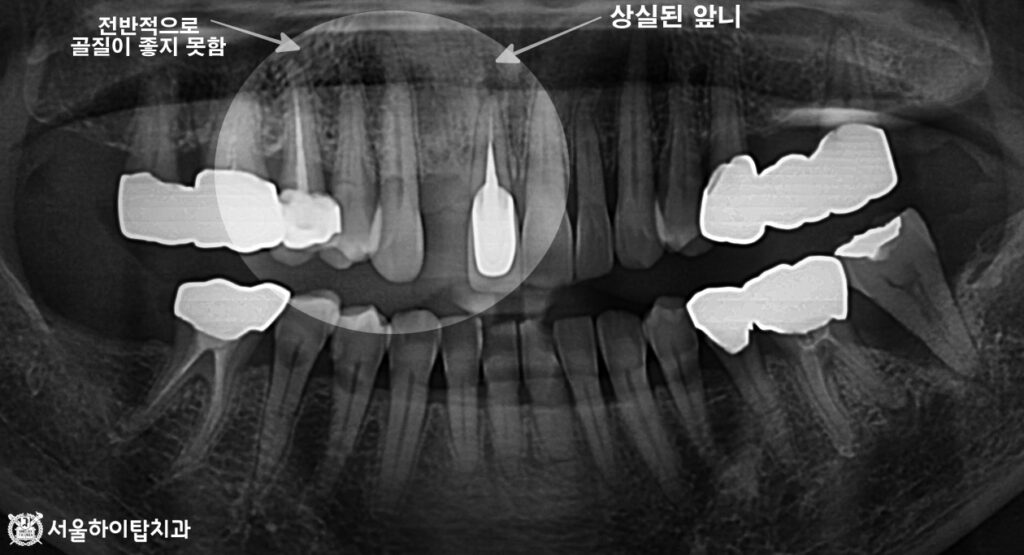 십정동 치과, 초진 파노라마 엑스레이,

상실된 앞니 치아와 그 주변 골질이 좋지 못함