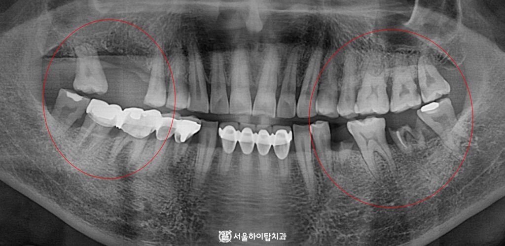 부평 치과, 초진 파노라마 엑스레이

양쪽 어금니에서 상실되고 파절된 어금니들이 다수 관찰됨.

현재 인접 치아 이동, 치조골 흡수, 교합 관계 불안정 등의 문제가 나타나고 있음.