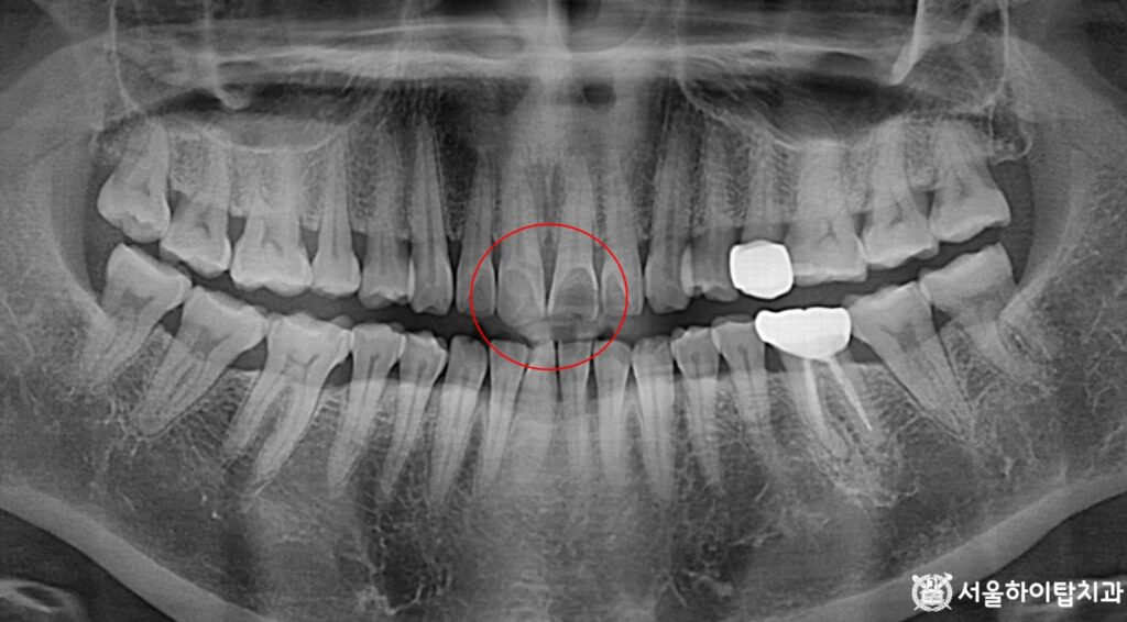 부평 치과 - 파노라마 엑스레이에서 큰 이상은 없으나 위턱 가운데 앞니에서 파절 소견이 의심됨 