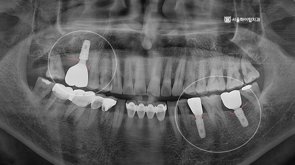 상, 하악 임플란트가 모두 심겨진 후
크라운수복까지 완료