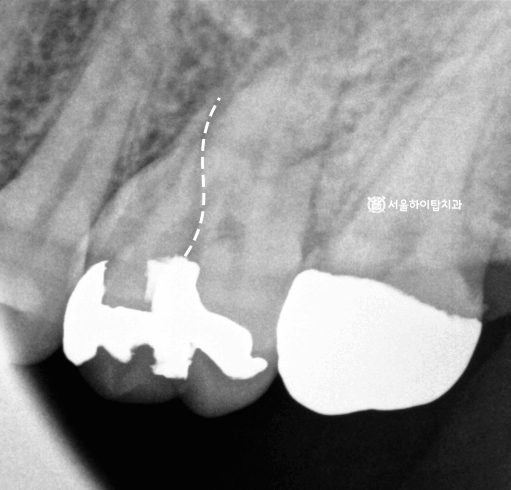만수동 치과, 파절선이 뿌리까지 이어진 모습