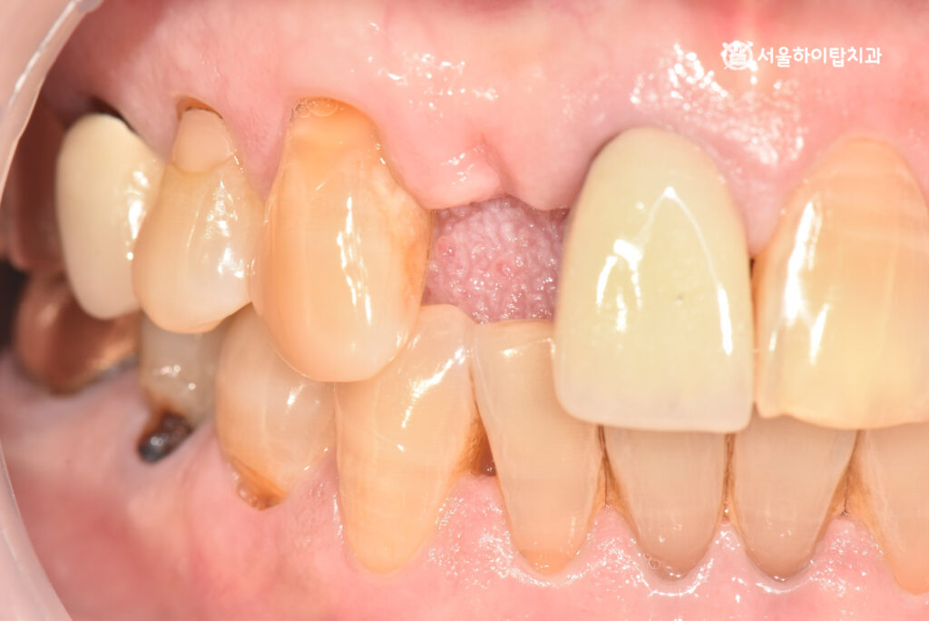 십정동 치과 상실된 치아 구강 모습으로 자세히 관찰

주변 인접 치아의 위치변동이 없음