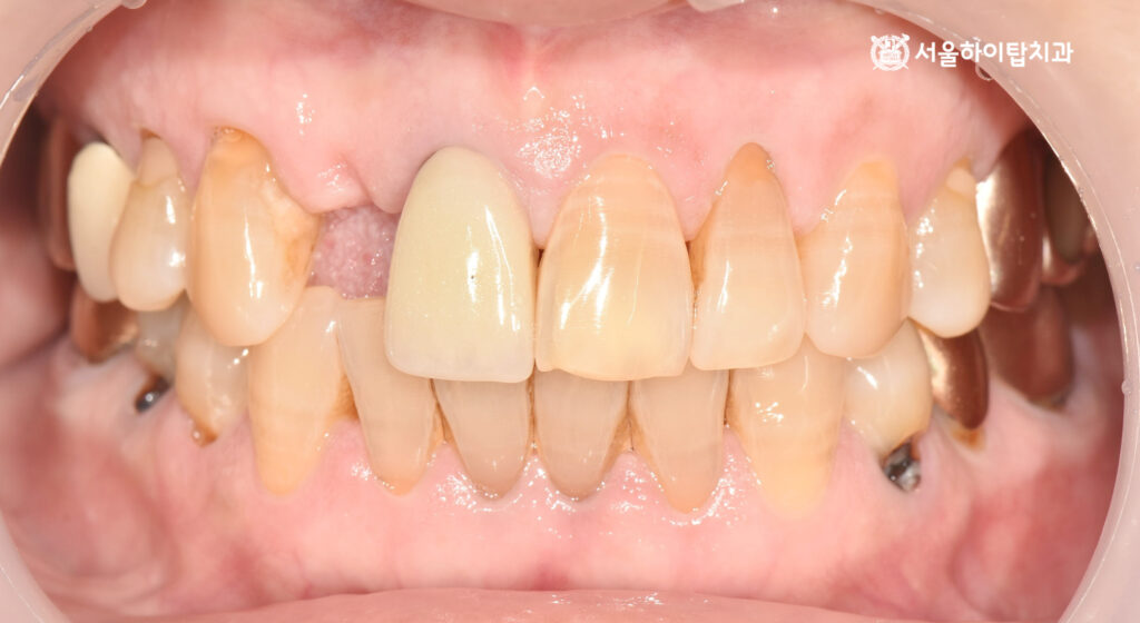 십정동 치과, 구강 정면 모습

전체적으로 잇몸 및 주변 치아들도 상태가 좋지 못함 (충치, 치석, 치태 등)