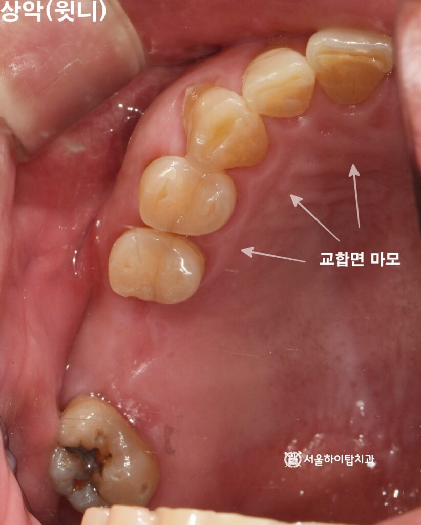 부평 치과 구강 내 상악 교합면 모습

교합 불균형으로 인해 저작이 앞니로 쏠리면서 앞니에 마모가 진행 중인 모습