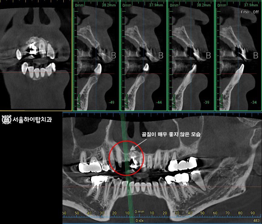 십정동 치과, 임플란트 식립을 위한 CT 촬영 골질이 좋지 못한 상태를 면밀히 확인 할 수 있음