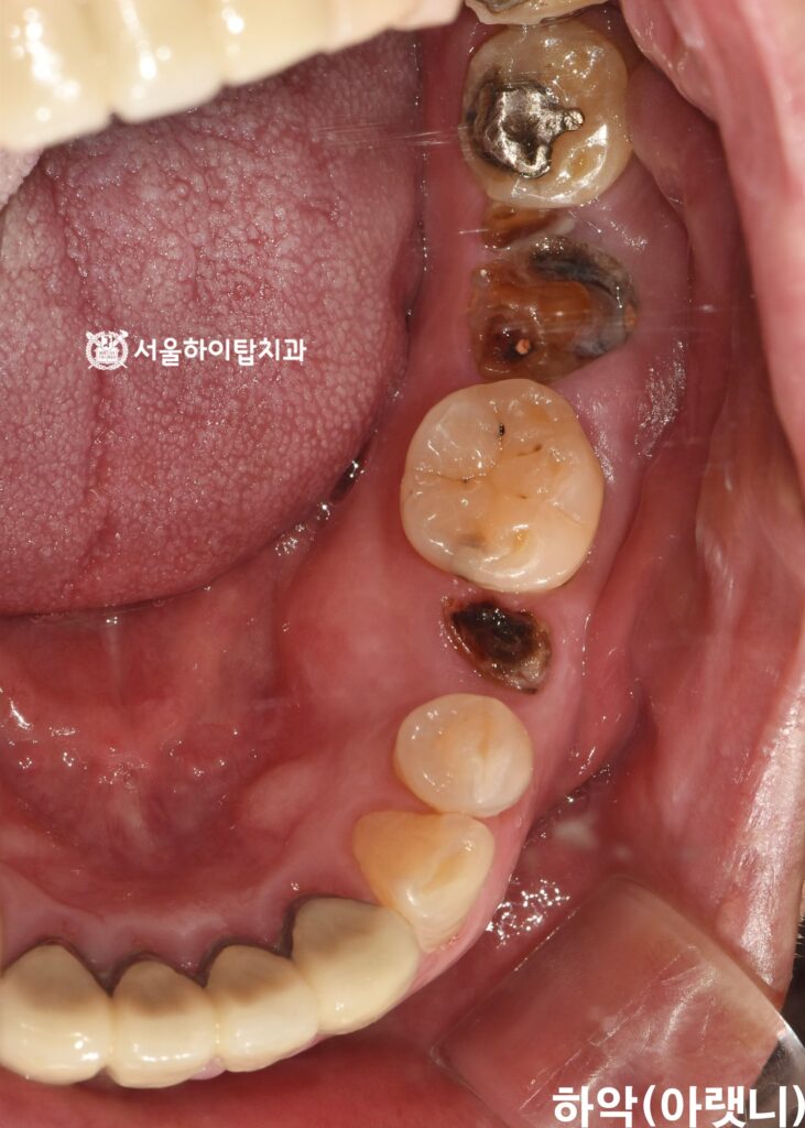 부평 치과 구강 내 하악 교합면 모습

기존 잔존치근 치아에서 충치가 진행 중
이는 잔존치근 상태에서 흔히 볼 수 있는 소견