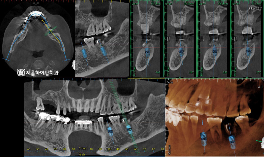 임플란트 식립을 위한
CT 촬영, 수술 가상 시뮬레이션